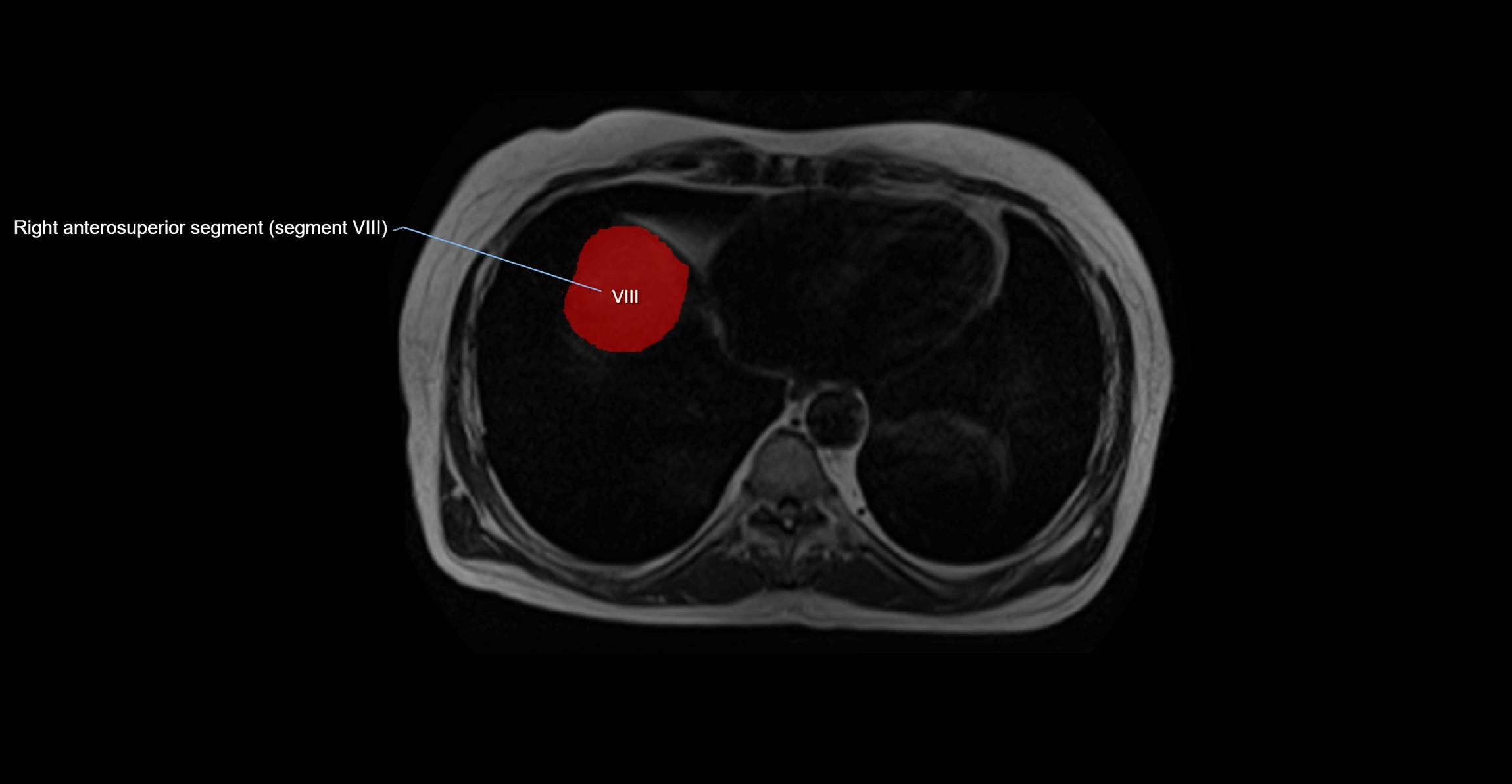 MRI  liver segments anatomy axial cross sectional 3T radiology  image-img-00001-00002.webp
